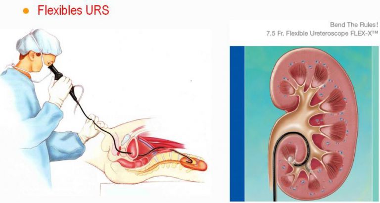 연질 요관 내시경