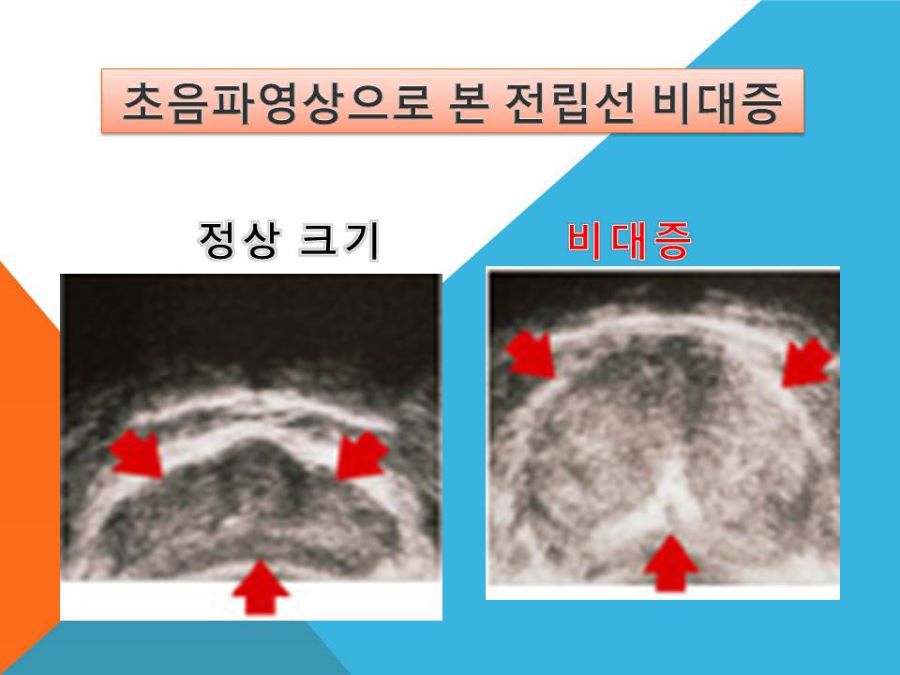 전립선의 크기 비교